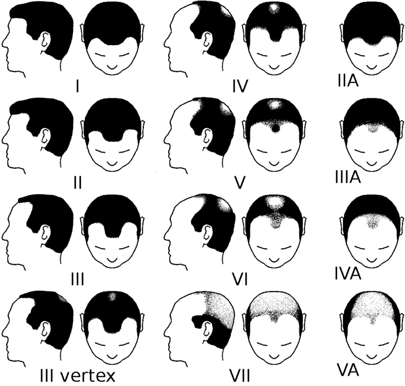 7-stades-de-la-calvitie-selon--James-Hamilton.png