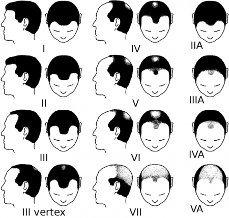 7-stades-de-la-calvitie-selon--James-Hamilton.png