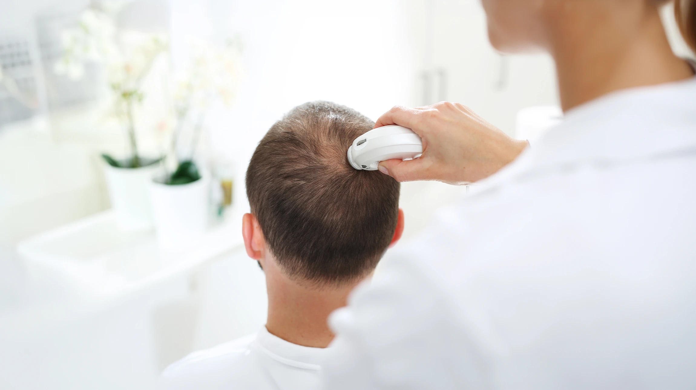 Vue de dessus d'un patient masculin après une greffe de cheveux, montrant la zone donneuse rasée à la nuque avec de nombreux points de prélèvement folliculaire cicatrisés